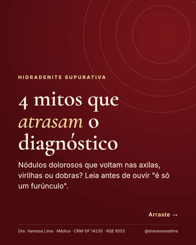 Hidradenite supurativa 4 mitos que atrasam o diagnóstico Nódulos dolorosos que voltam nas axilas, virilhas ou dobras? Leia antes de ouvir 'é só um furúnculo'.