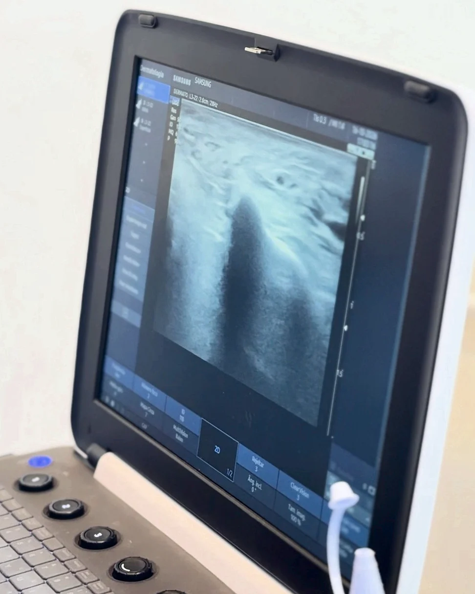 Tela do aparelho de ultrassom dermatológico mostrando as camadas da pele em tempo real